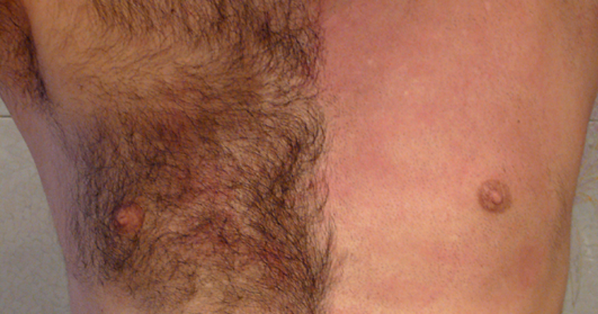 Epilation