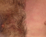 Epilation