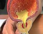 Les bienfaits de la masturbation contre le cancer de prostate