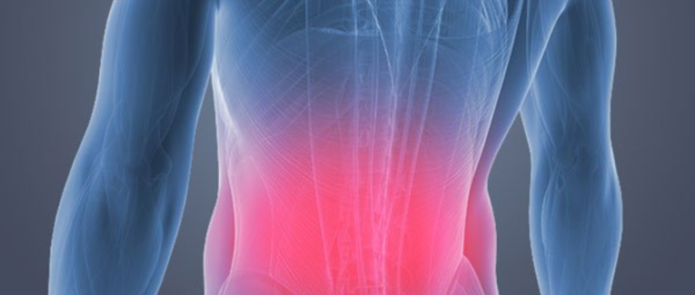 Contracture