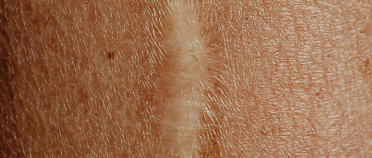 Cicatrice