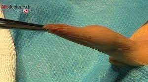 Circoncision